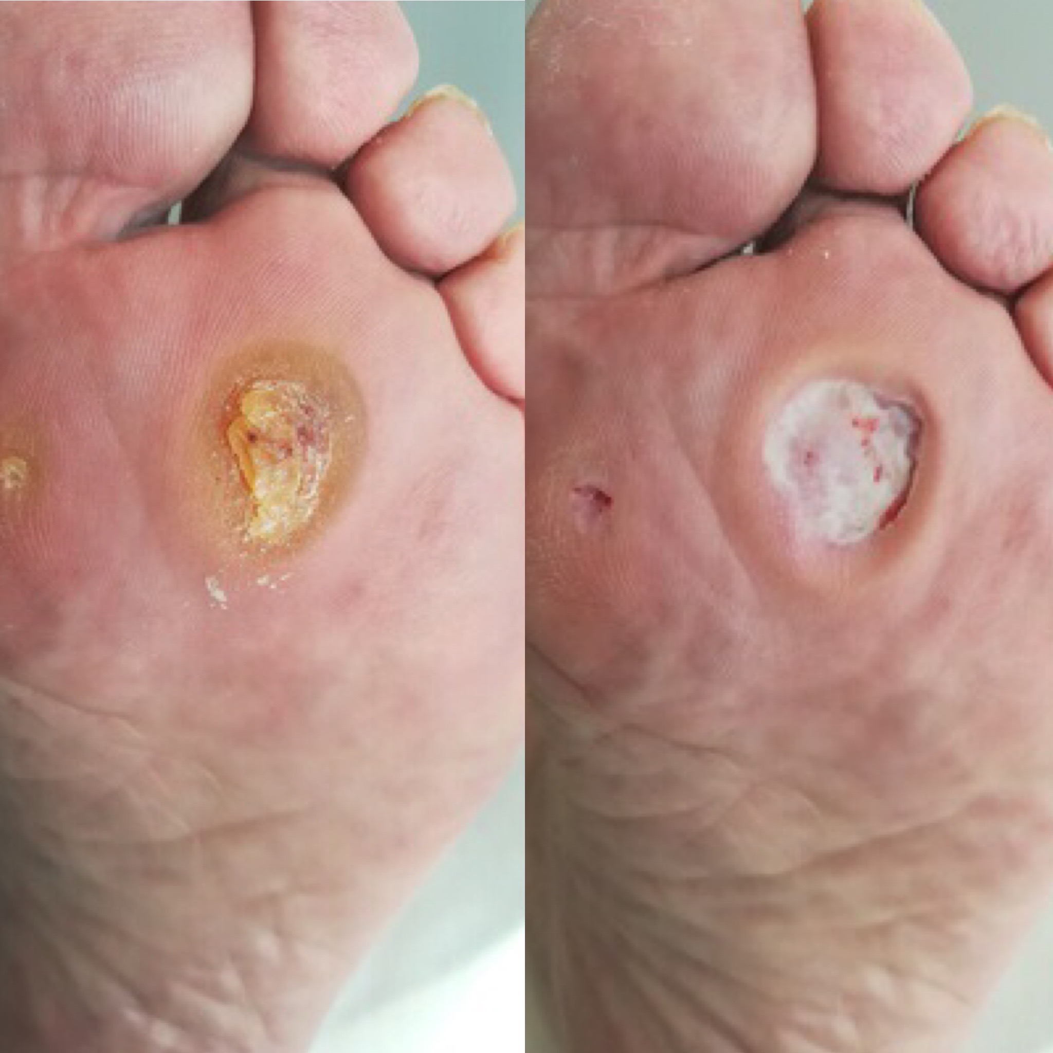 Pedicure podologiczny u osób ze stopą cukrzycową