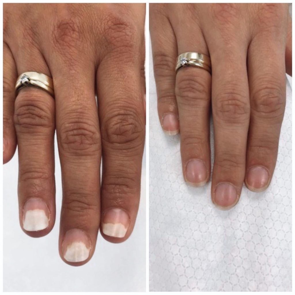 onycholiza terapia Lunula