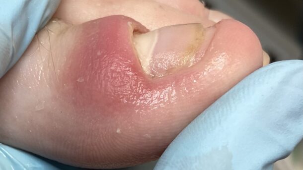retronychia