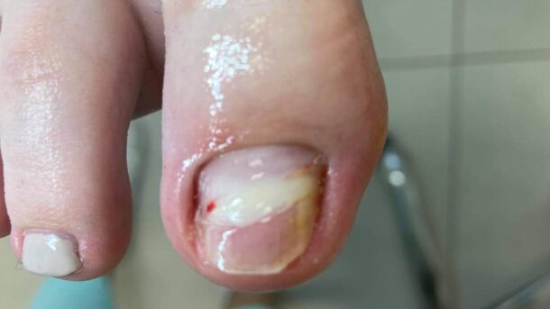 retronychia