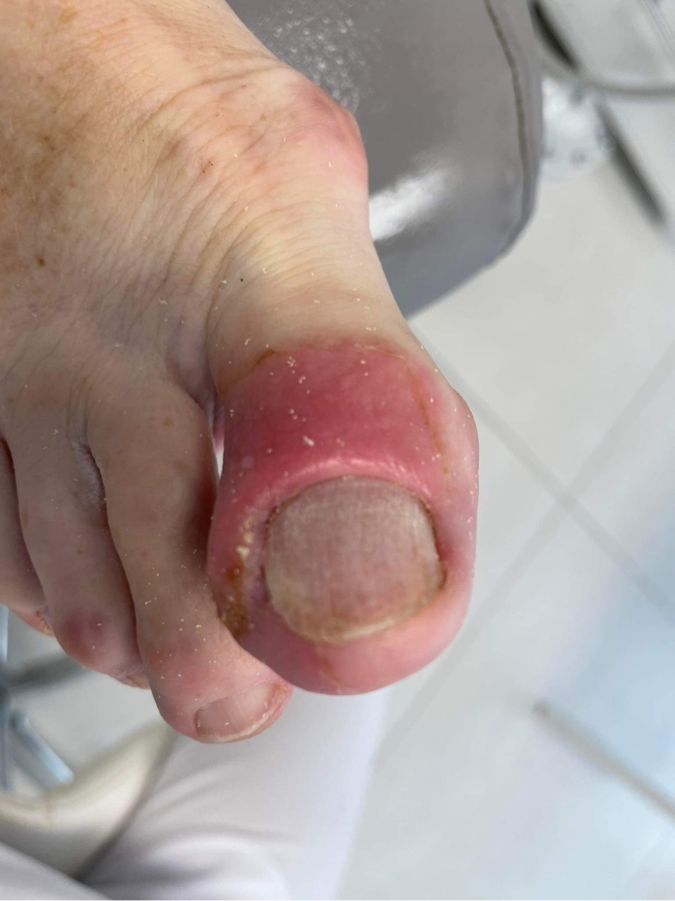 retronychia