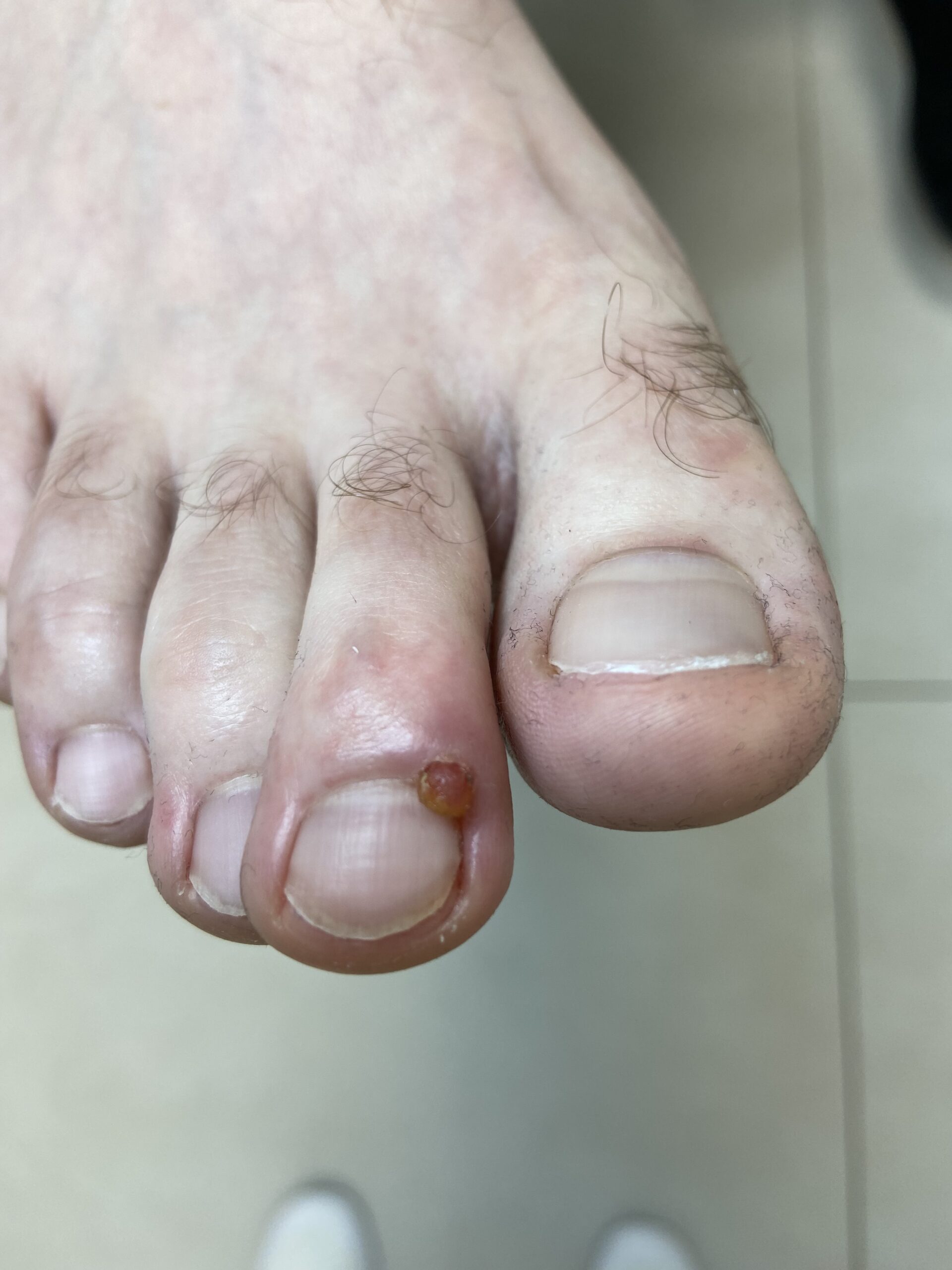 Fibroma
