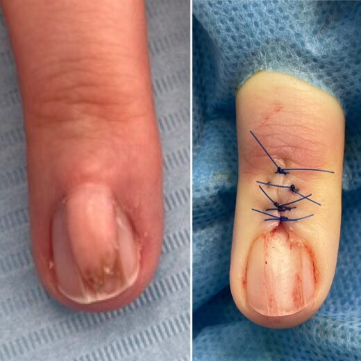 fibroma