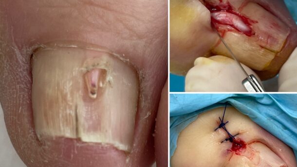 fibroma