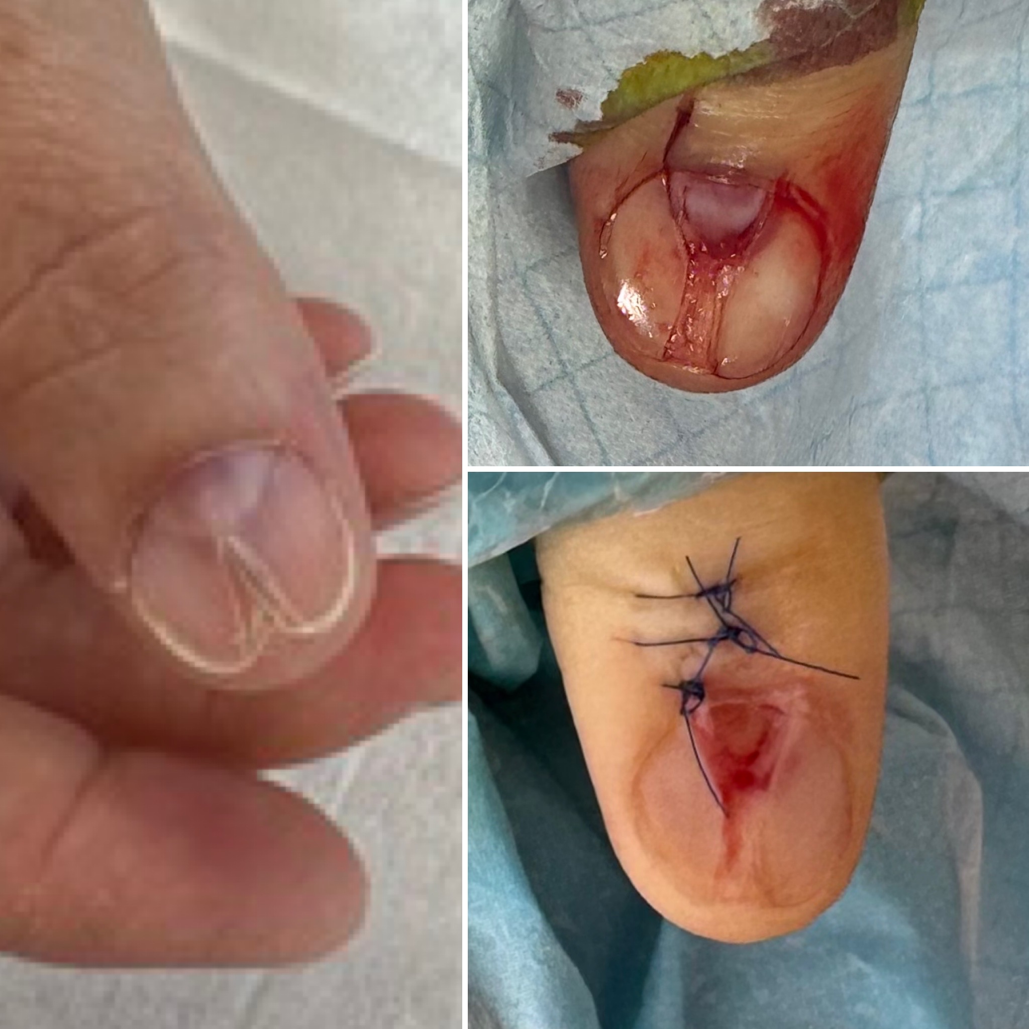fibroma zabieg podochirurgiczny