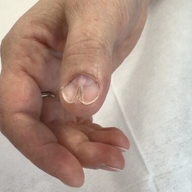 Czym jest onychopapilloma?