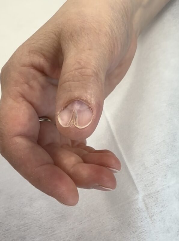 onychopapilloma